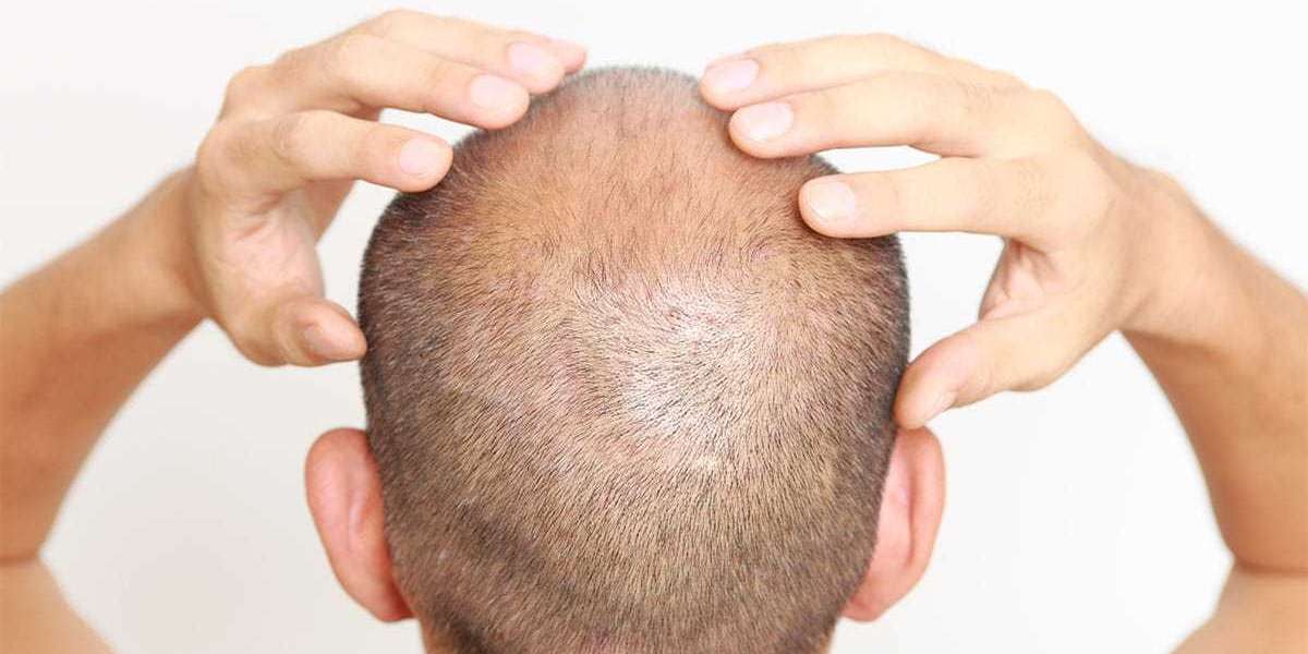 A hair transplant falls out after one year